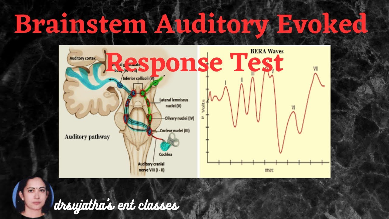 210.Brainstem Evoked Response Audiometry BERA Part 2/2 #bera #oae #screening