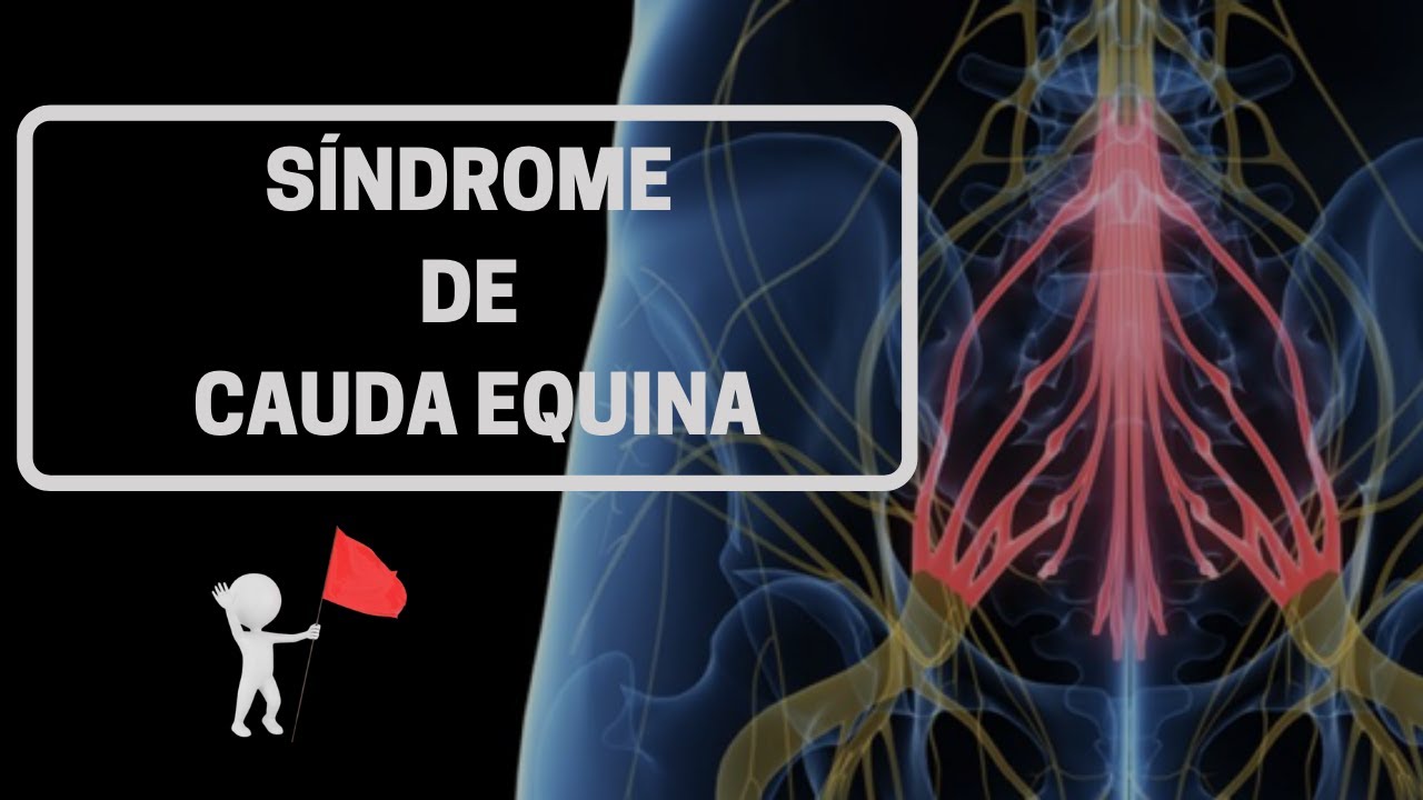 S&Iacute;NDROME DE CAUDA EQUINA