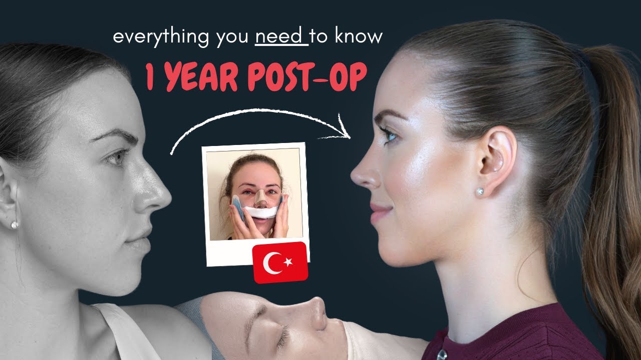 Rhinoplasty in Turkey | 1 Year Post-Op Nose Job Update + Q&A (2025)