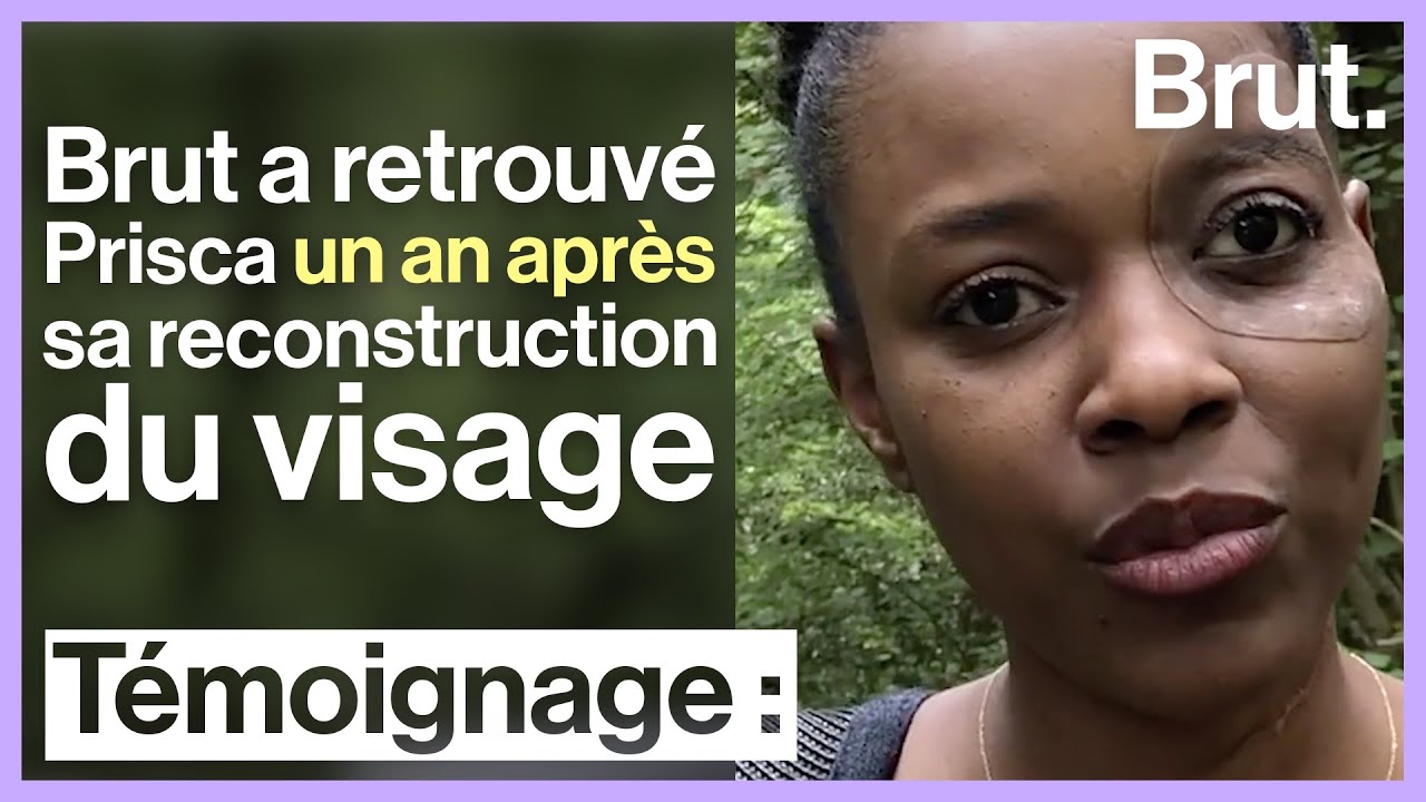 Reconstruction du visage : 1 an après, Prisca et sa prothèse d'œil
