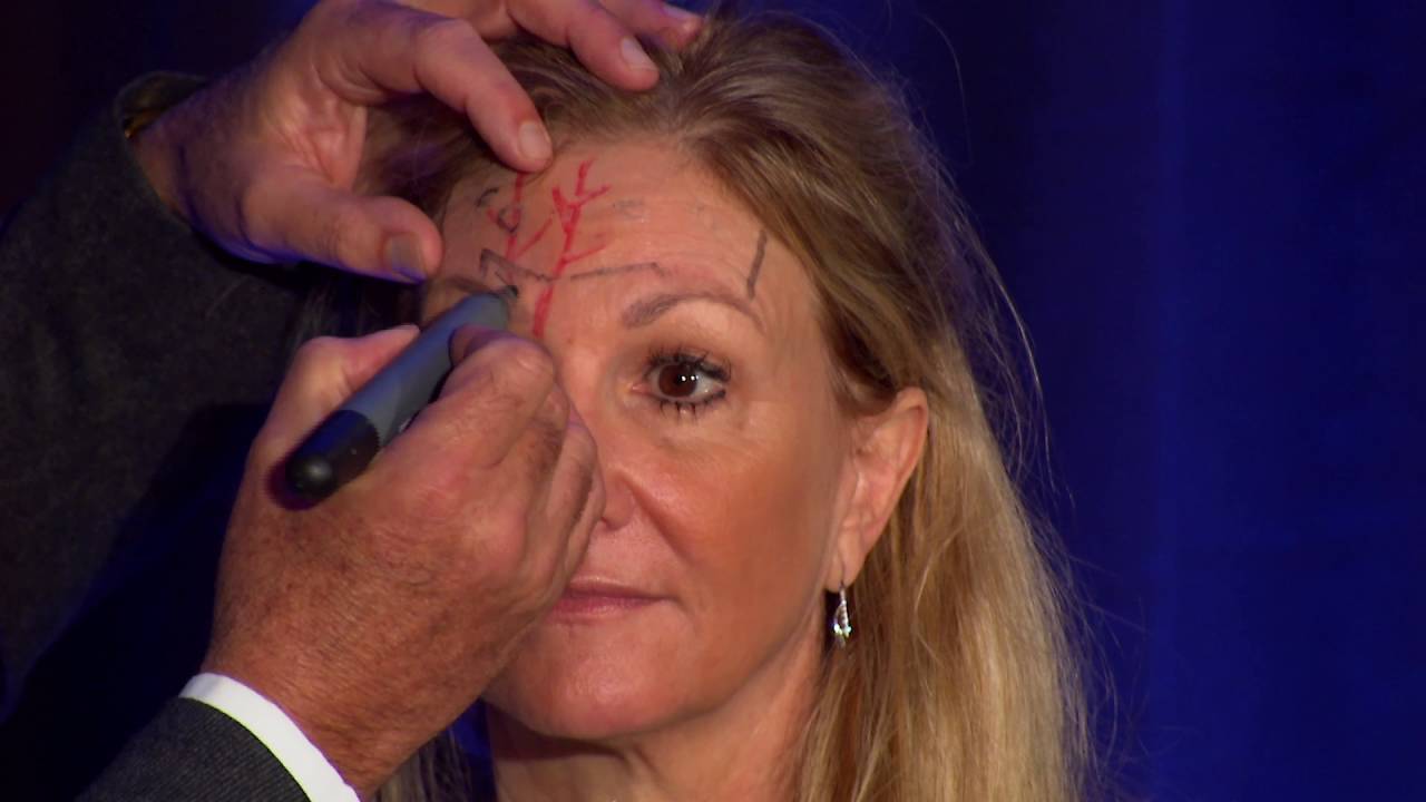 Injectors Anatomy of the Forehead