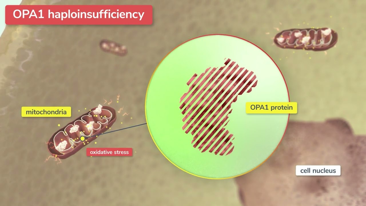 Stoke Therapeutics - Autosomal Dominant Optic Atrophy (ADOA)