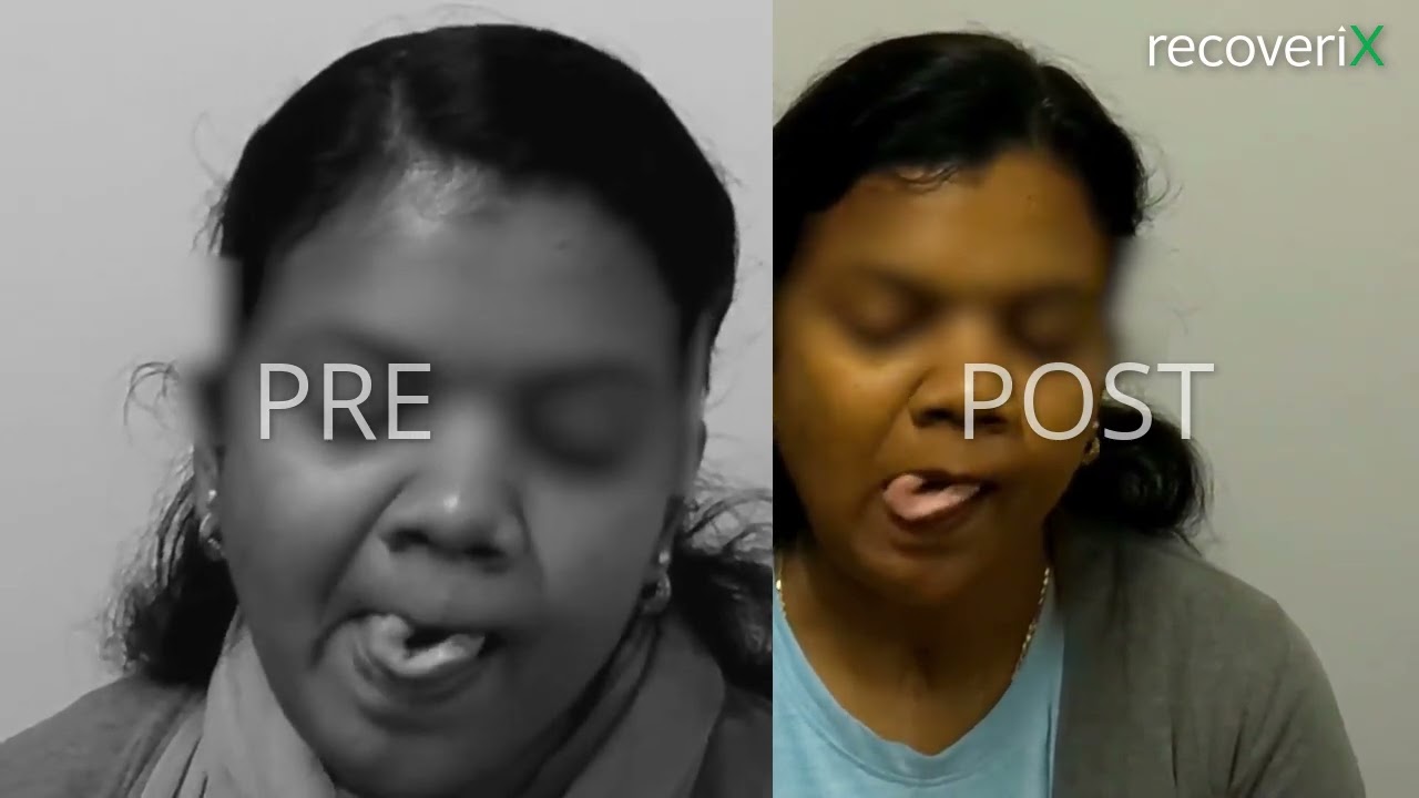 Before/After recoveriX - stroke - Tongue movement - ST1S