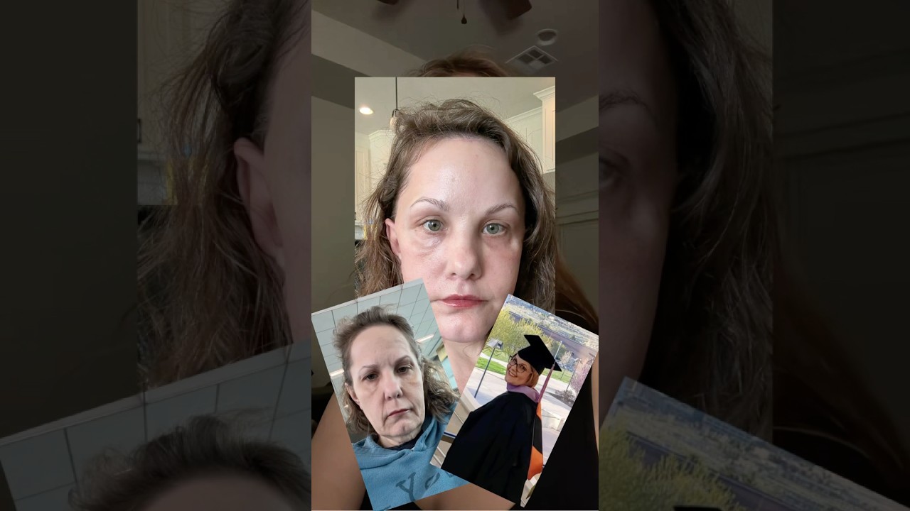 Michelle woods before and after facelift