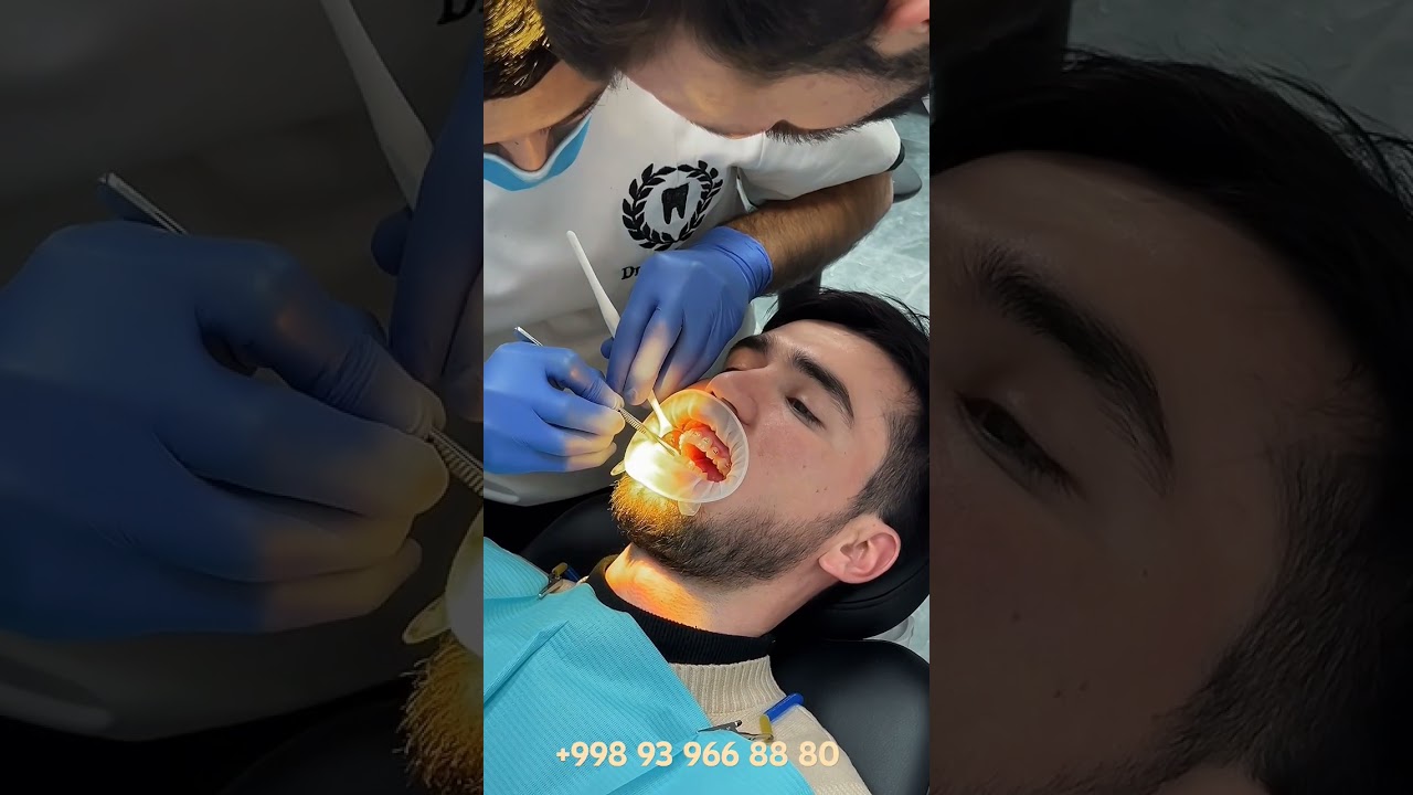 Sapfir breket qoʻyish jarayoni +998939668880 #stomatolog #implant #tish #tishimplanti