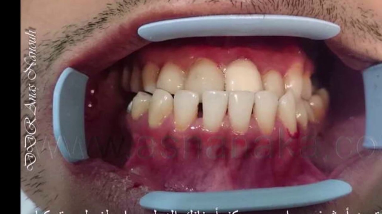 علاج اسنان العضة المعكوسة بدون جراحة أو تقويم خلال أسبوع