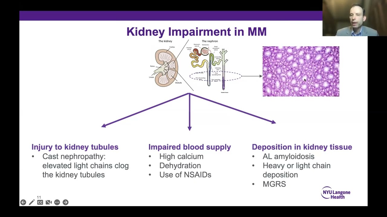 Using REVLIMID as a Successful Treatment for Myeloma Patients with Kidney Involvement