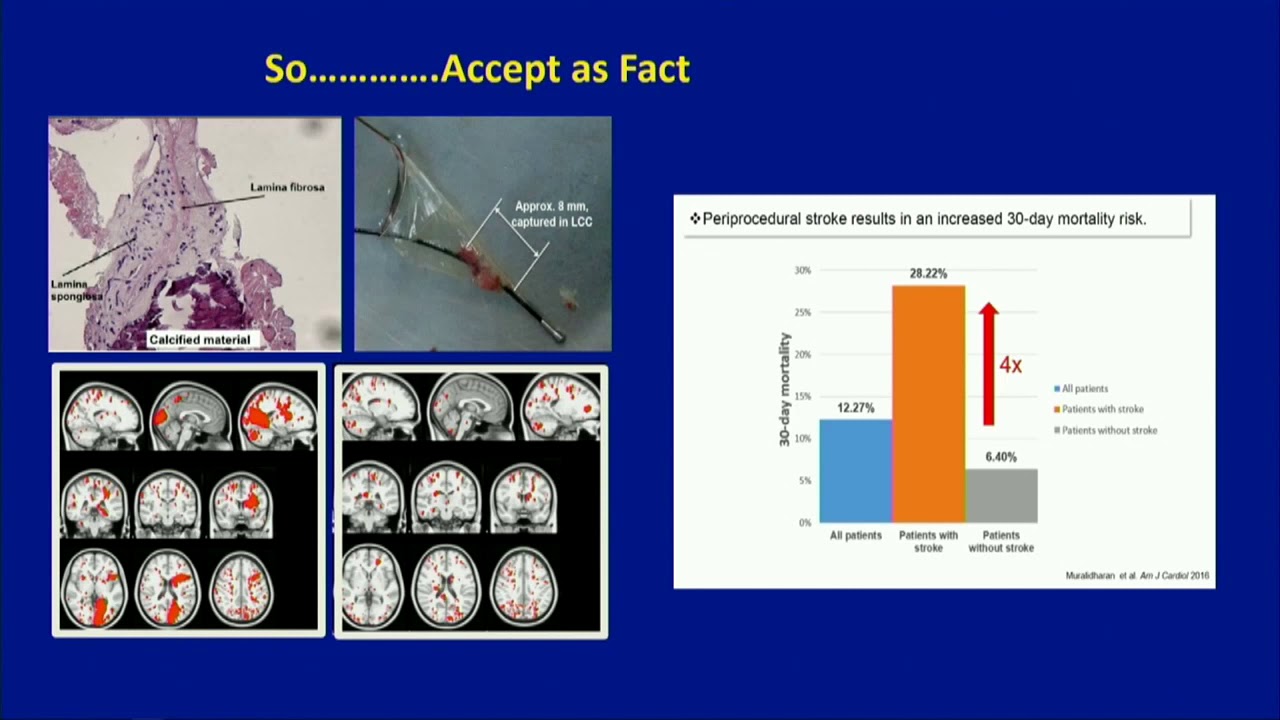 CVI 2019_Friday 7/19_ Innovations in Structural Heart Therapy_David Brown, MD
