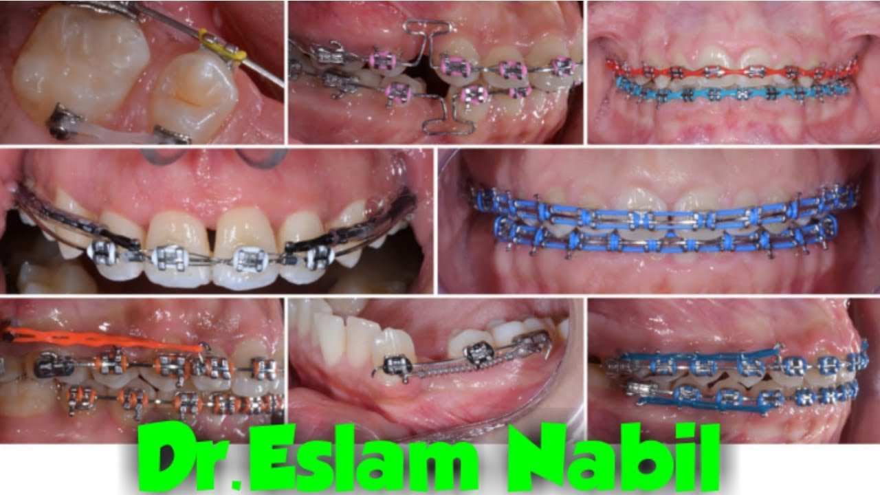 Orthodontic Space Closure Techniques - Braces - طرق غلق المسافات - تقويم الأسنان