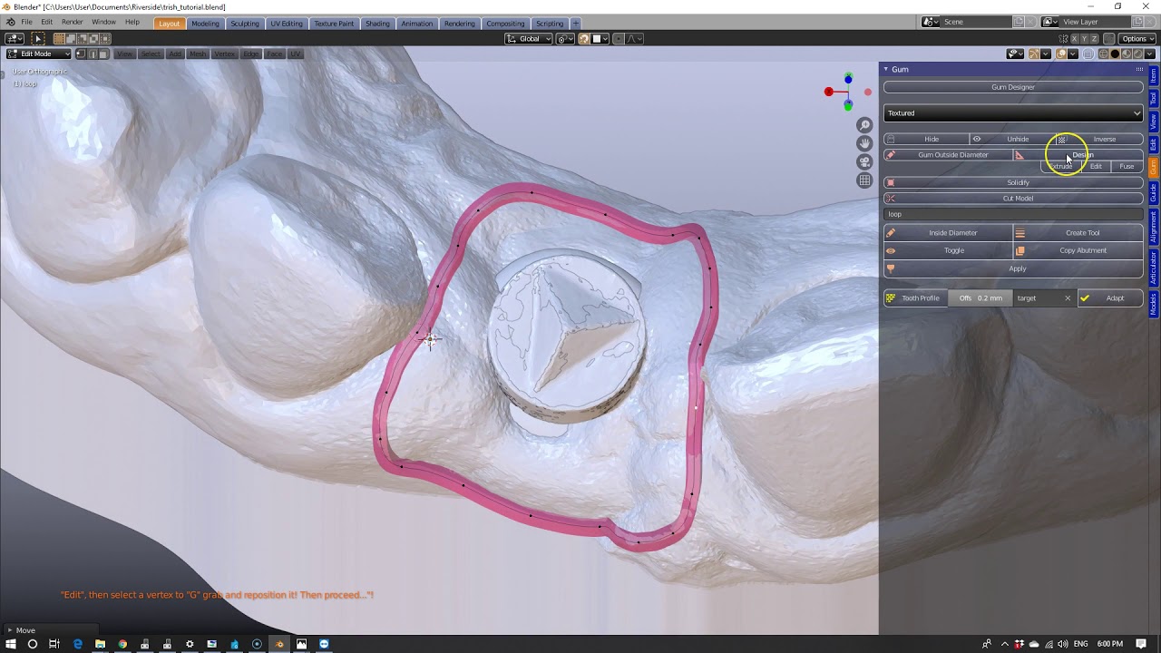 B4D Implant Analog Placement