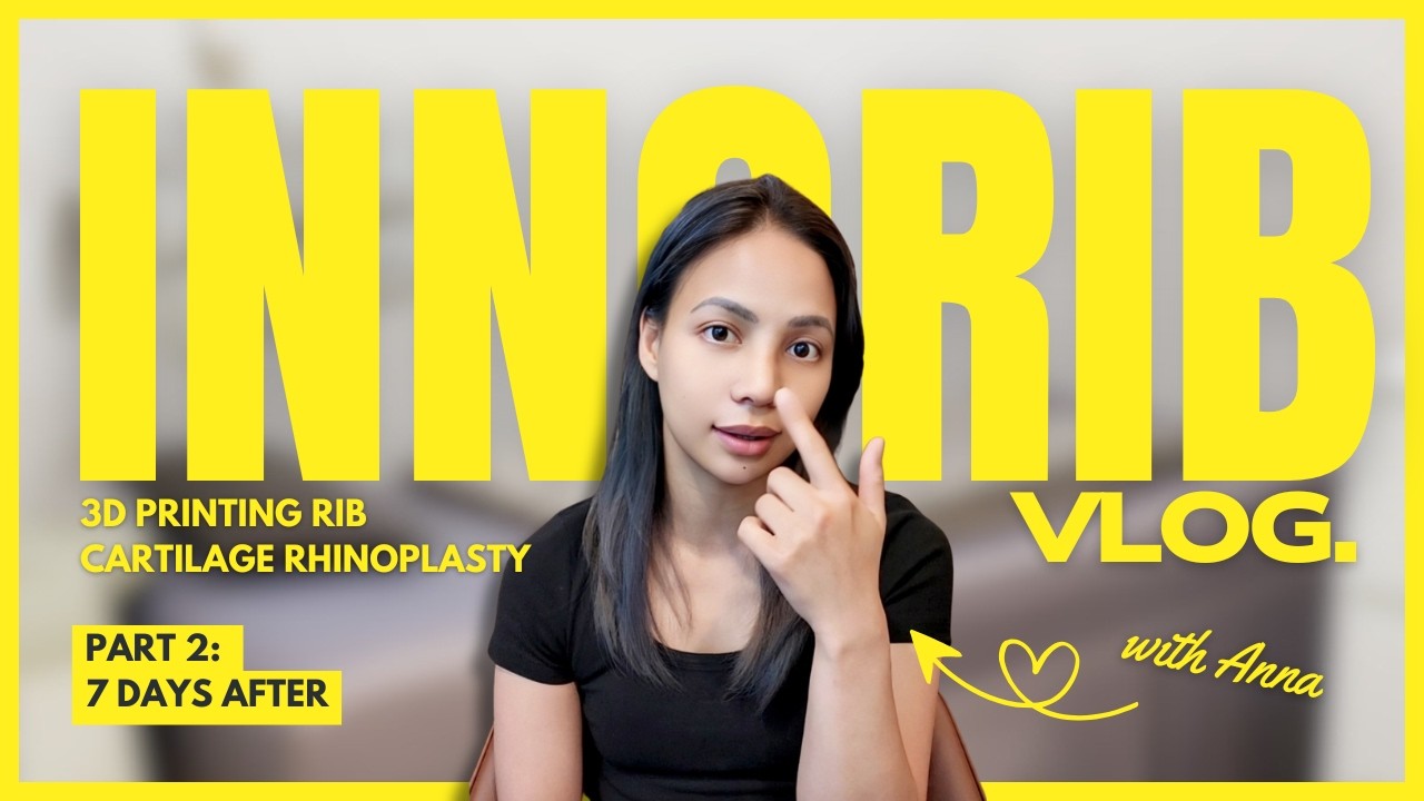 Anna's 3D Printed Asian Rhinoplasty Journey ✨👃 | INNOFIT Rib Cartilage | Part 2 @ JW Plastic Surgery