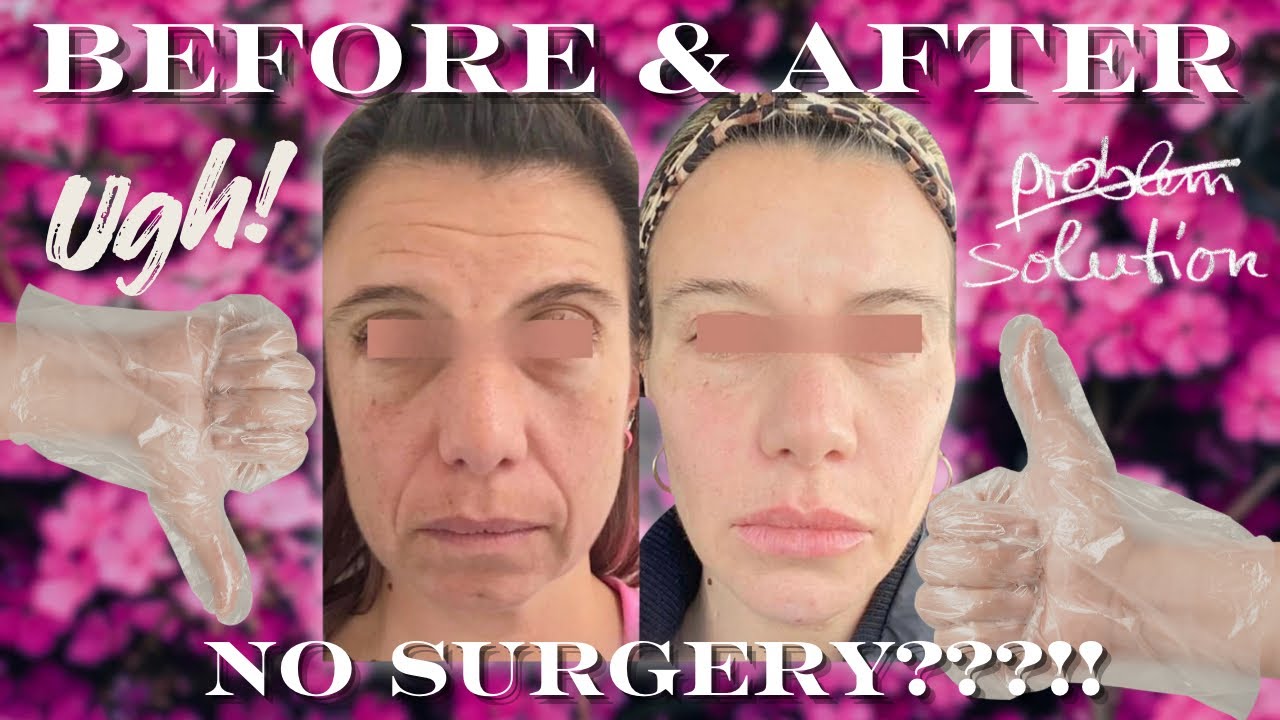 Before & After Face Injections | No Surgery?! Deb’s Real Results at Allure Aesthetics (KOP, PA)