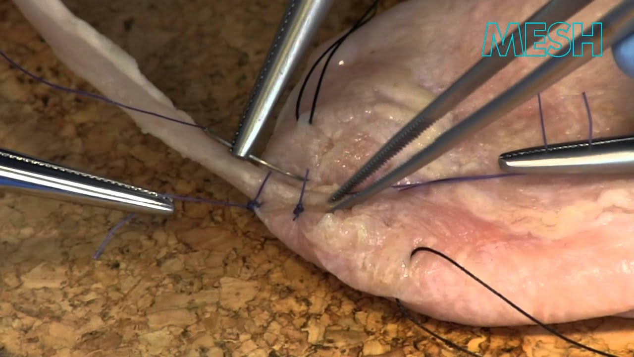 Ureteric reimplantation extravesical