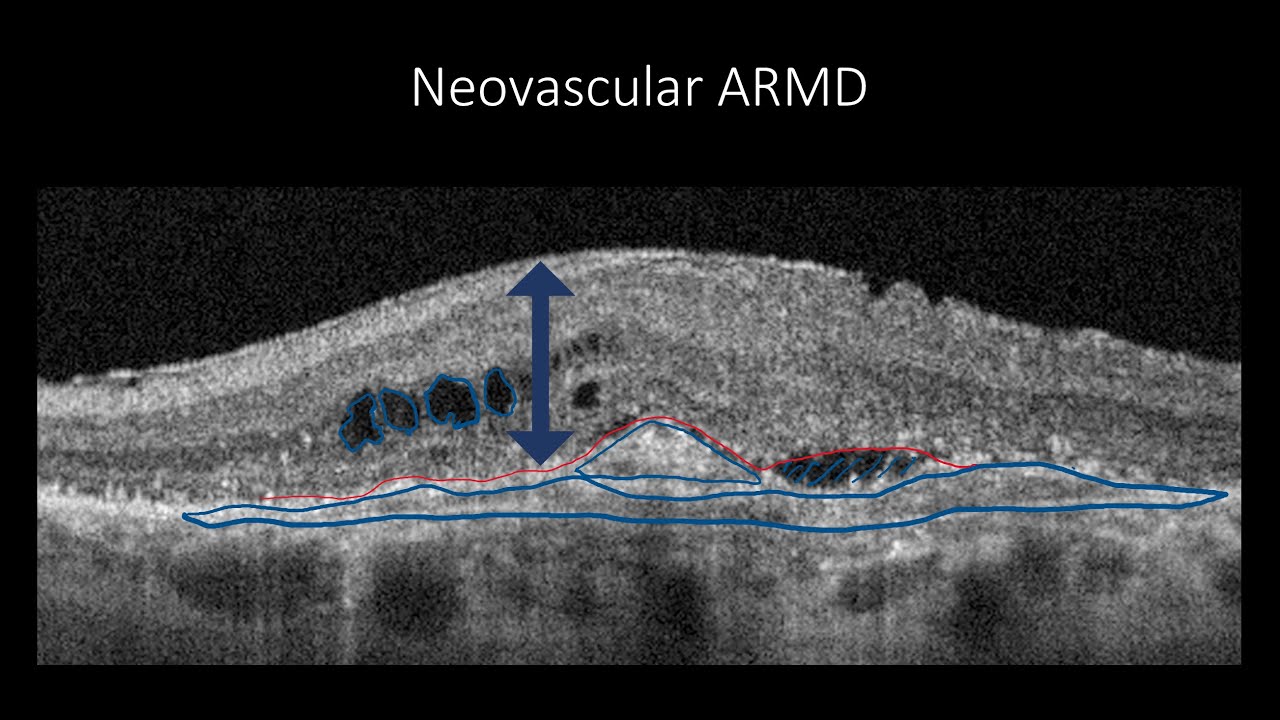 Course in clinical applications of OCT for macular diseases - Neovascular ARMD