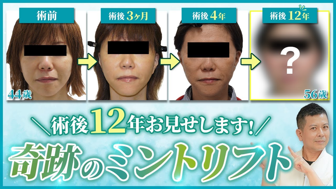 【奇跡の症例】術後なんと12年！有名クリニックの切るフェイスリフトよりも効果あり！？シンシアのミントリフトの術後経過やダウンタイムについて徹底解説！