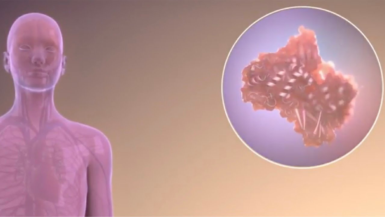 An Inside Look at Fabry Disease