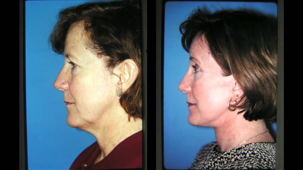 NASHVILLE Facelift, Browlift, Eyelid Lift, Laser Resurfacing FACIAL PLASTIC SURGERY BEFORE AND AFTER