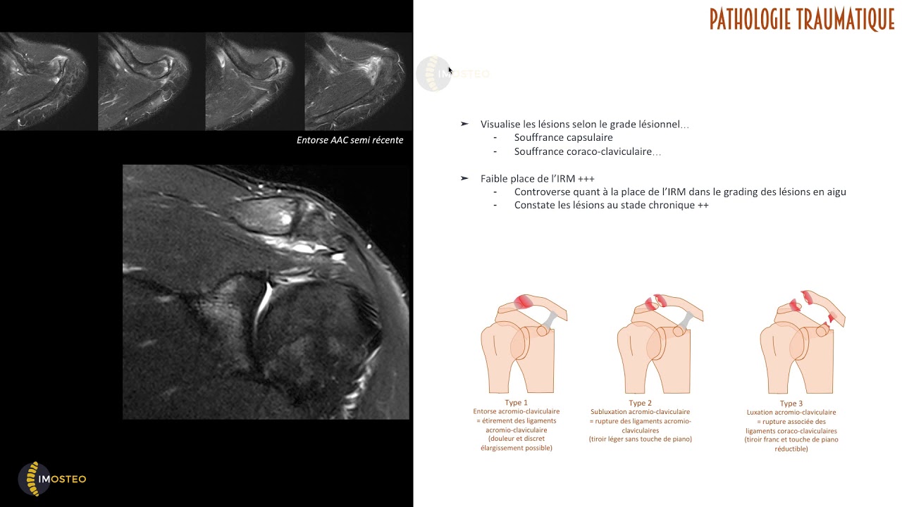 TUTORIEL IMOSTEO #15 : IRM de l'articulation acromio-claviculaire