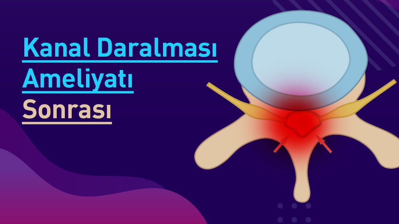 Kanal Daralması Ameliyatı Sonrası Dikkat Edilmesi Gerekenler ve İyileşme Süreci