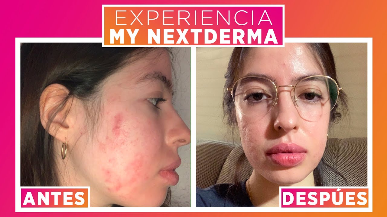 Experiencia My NextDerma / Testimonio de Selma Derma