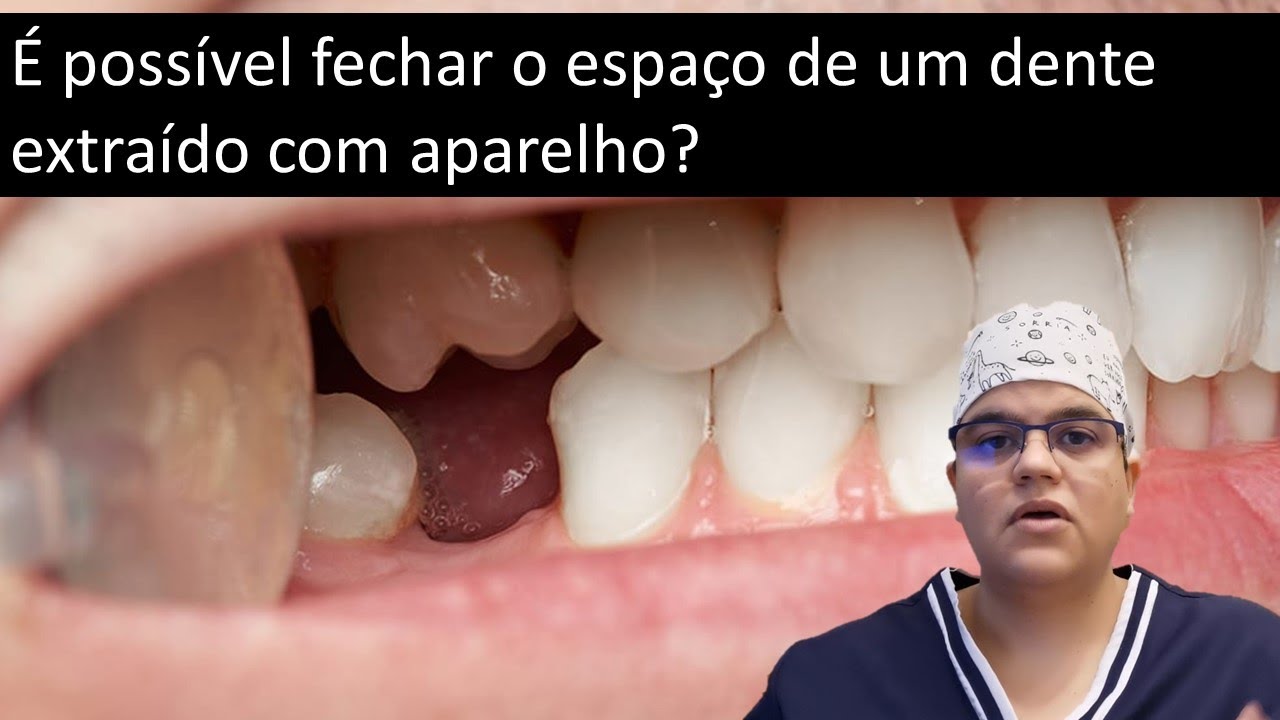 É possível fechar com aparelho o espaço de um dente extraído?| Dra Bianca Rosa | Clínica Bianca Rosa