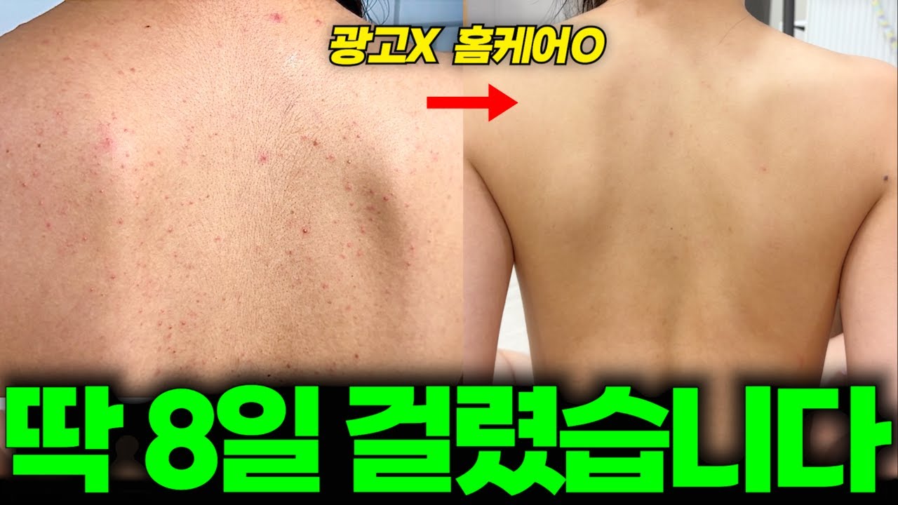 광고❌ 피부과에 쓸 300만원 아끼고 집에서 8일만 해보세요 | 하루만에 효과보는 등드름 없애는 법