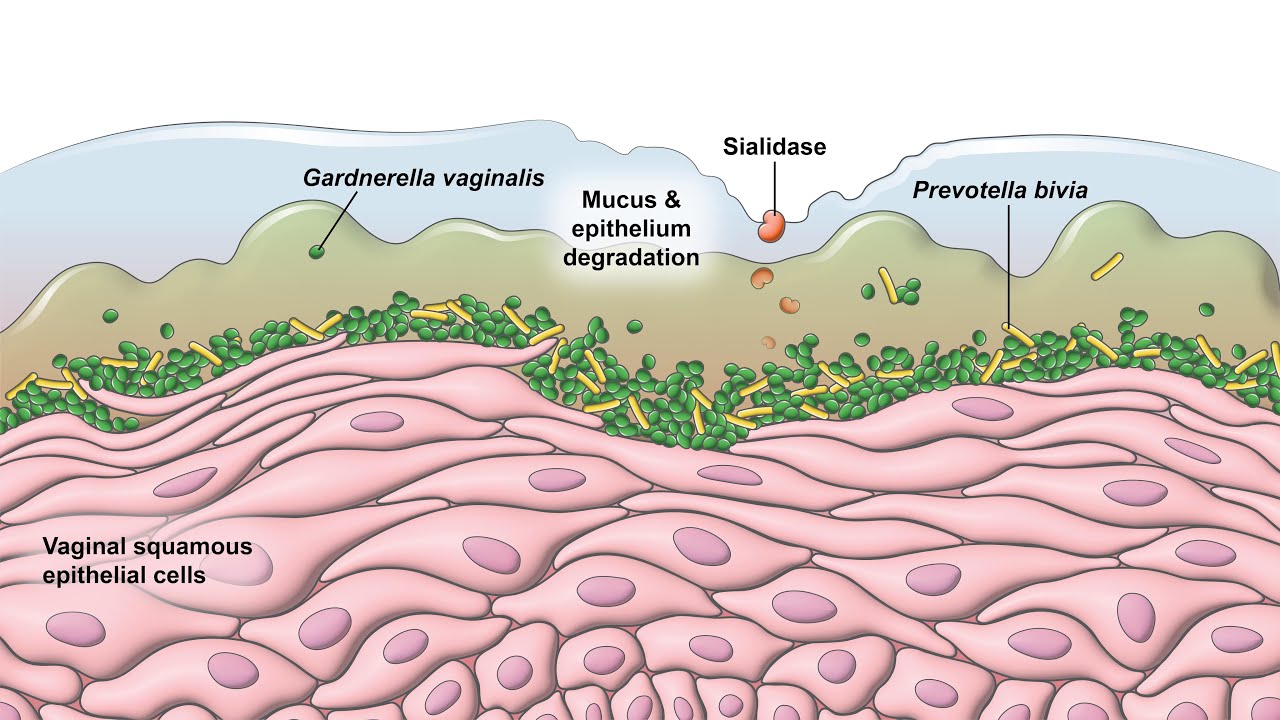Bacterial Vaginosis - Pathogenesis
