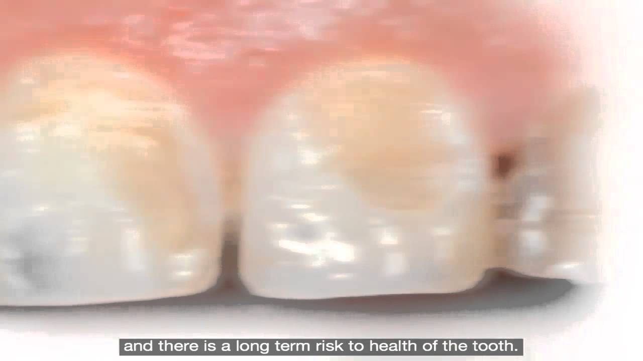Common Dental Problems: Erosion