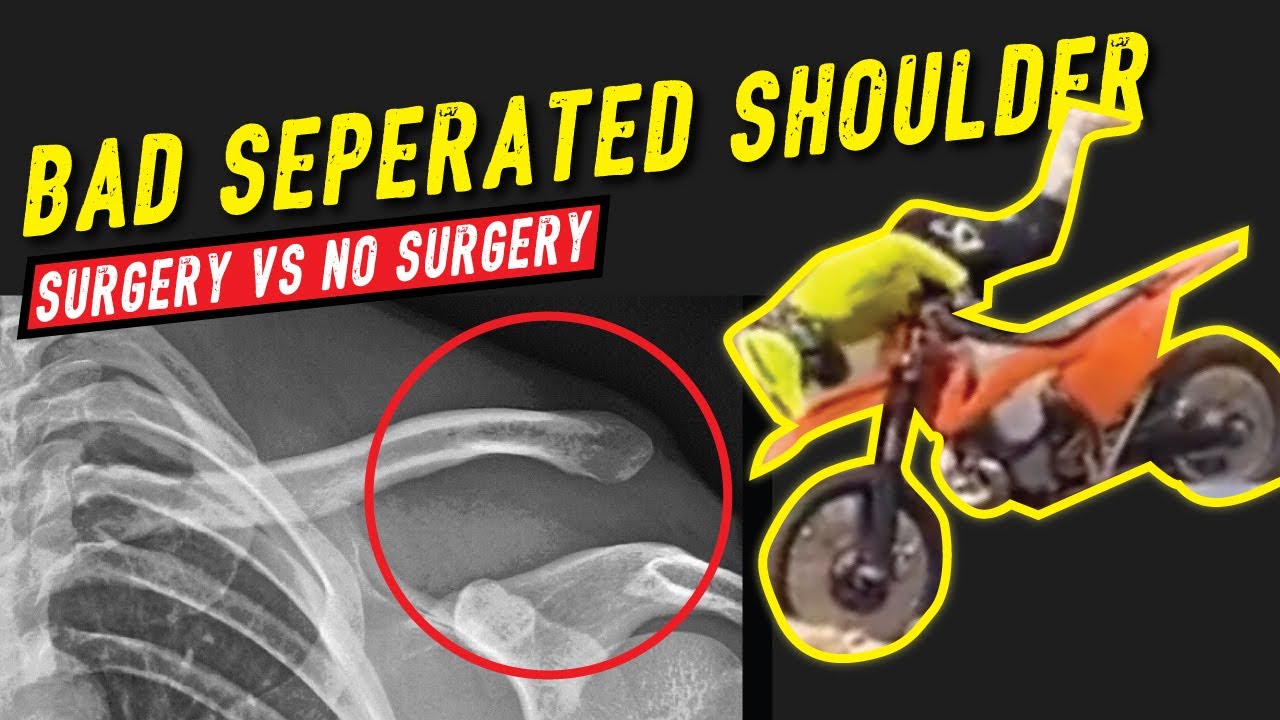Enduro Crash Separated Shoulder Grade 5: Surgery vs No Surgery
