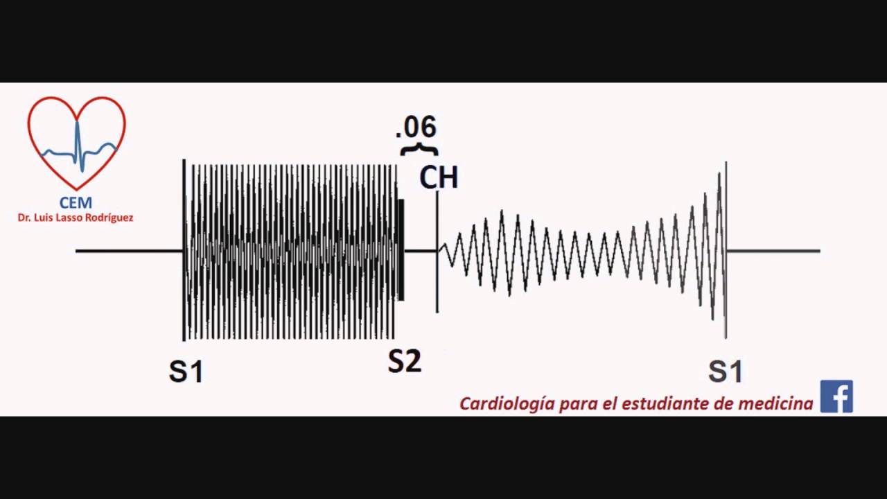 Soplo de la doble lesion valvular mitral