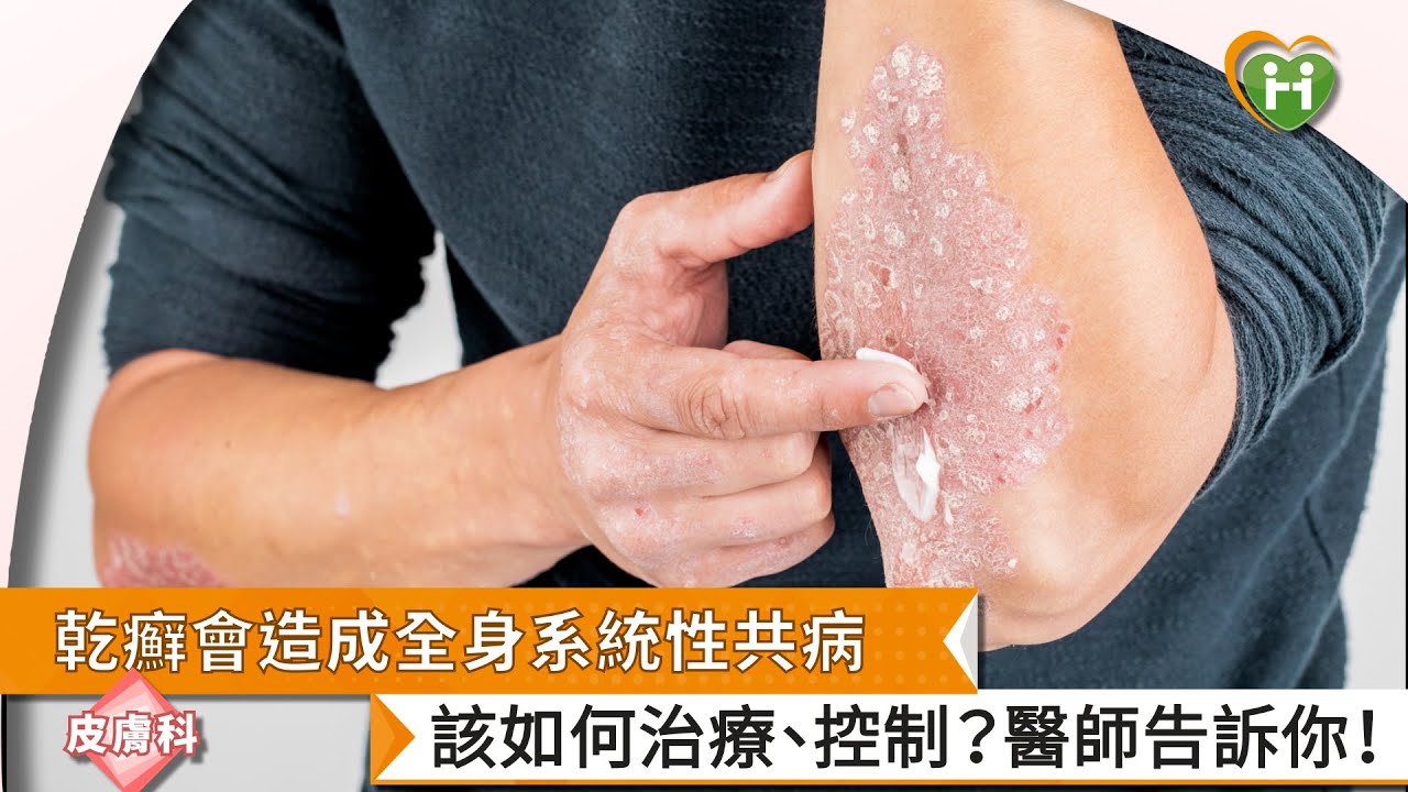 【盧俊瑋醫師】乾癬會造成全身系統性共病　該如何治療、控制？醫師告訴你！