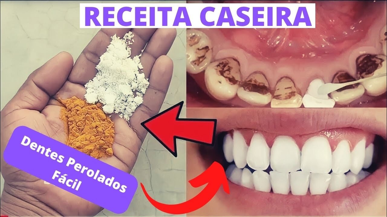 Como Clarear Seus Dentes Sem Gastar Dinheiro - 2 Receitas  Caseira  Muito F&aacute;cil de Fazer em 1 Minuto