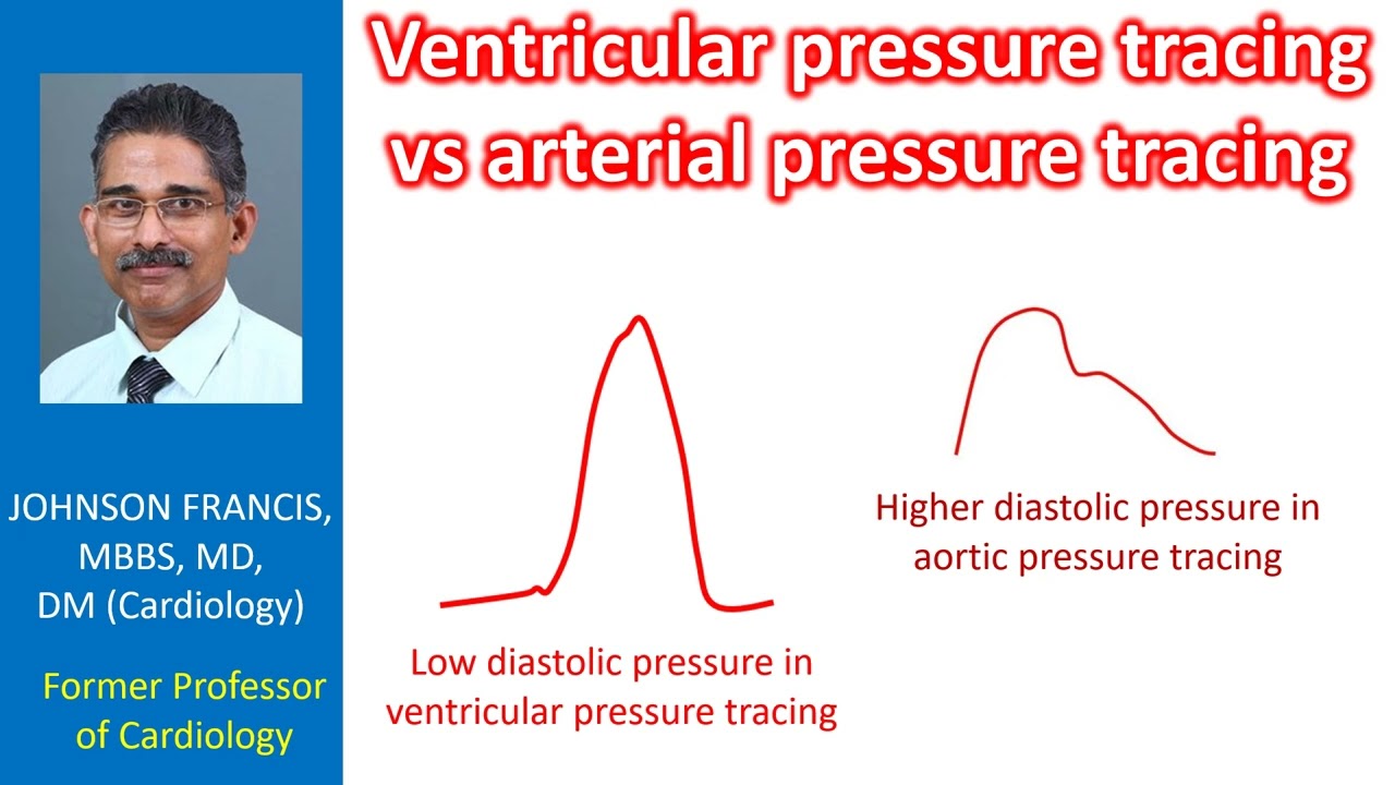 Ventricular pressure tracing vs arterial pressure tracing