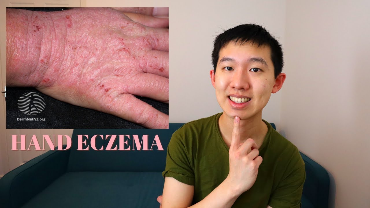 MANAGEMENT OF HAND DERMATITIS/ ECZEMA