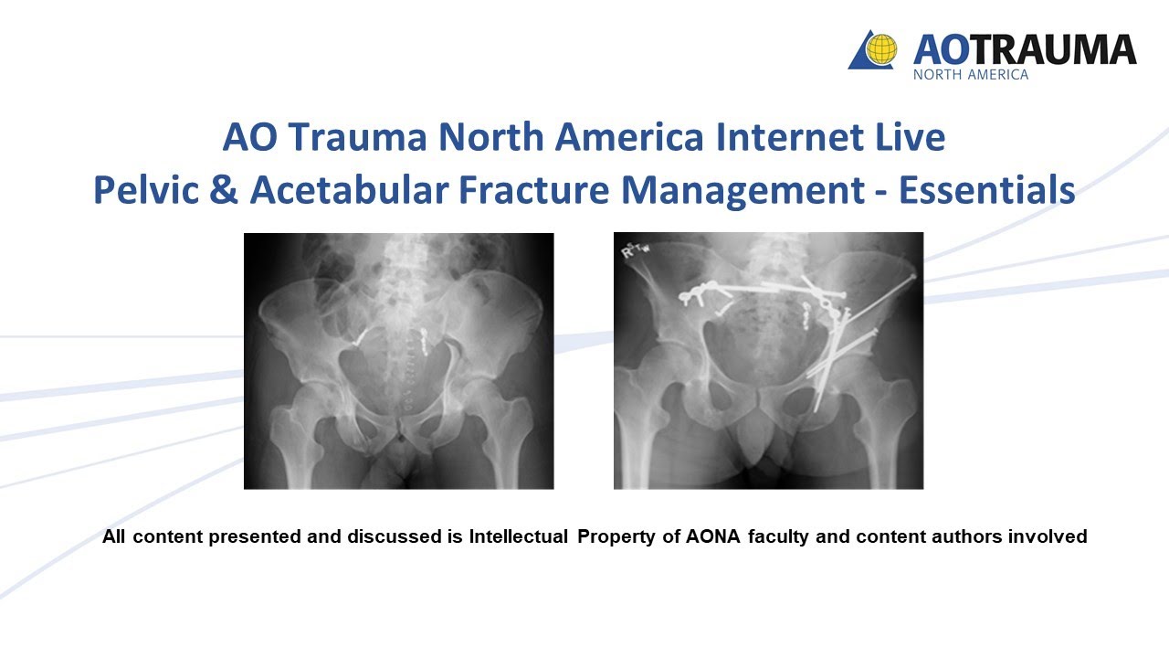 Radiology and Classification of Acetabular Fractures- Dr. Stephen Sims