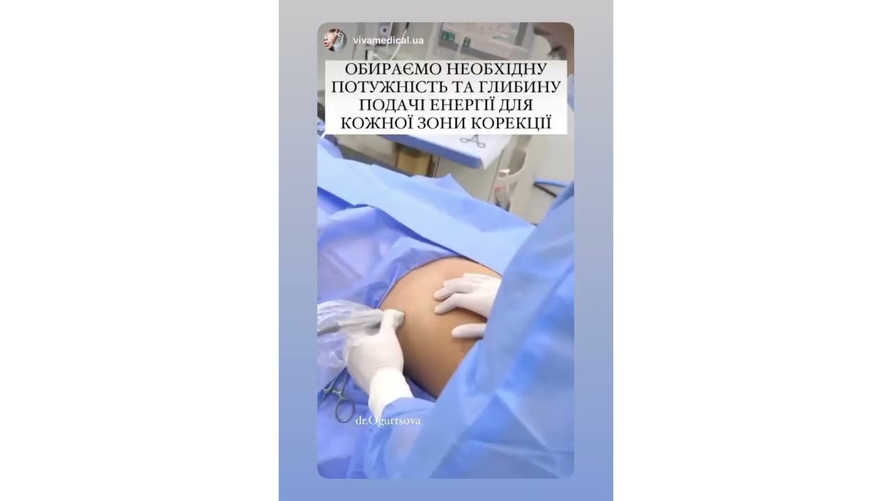 Голковий ліфтинг шкіри та усунення розтяжок на тілі Fractora в клініці Vivamedical Aesthetic Club