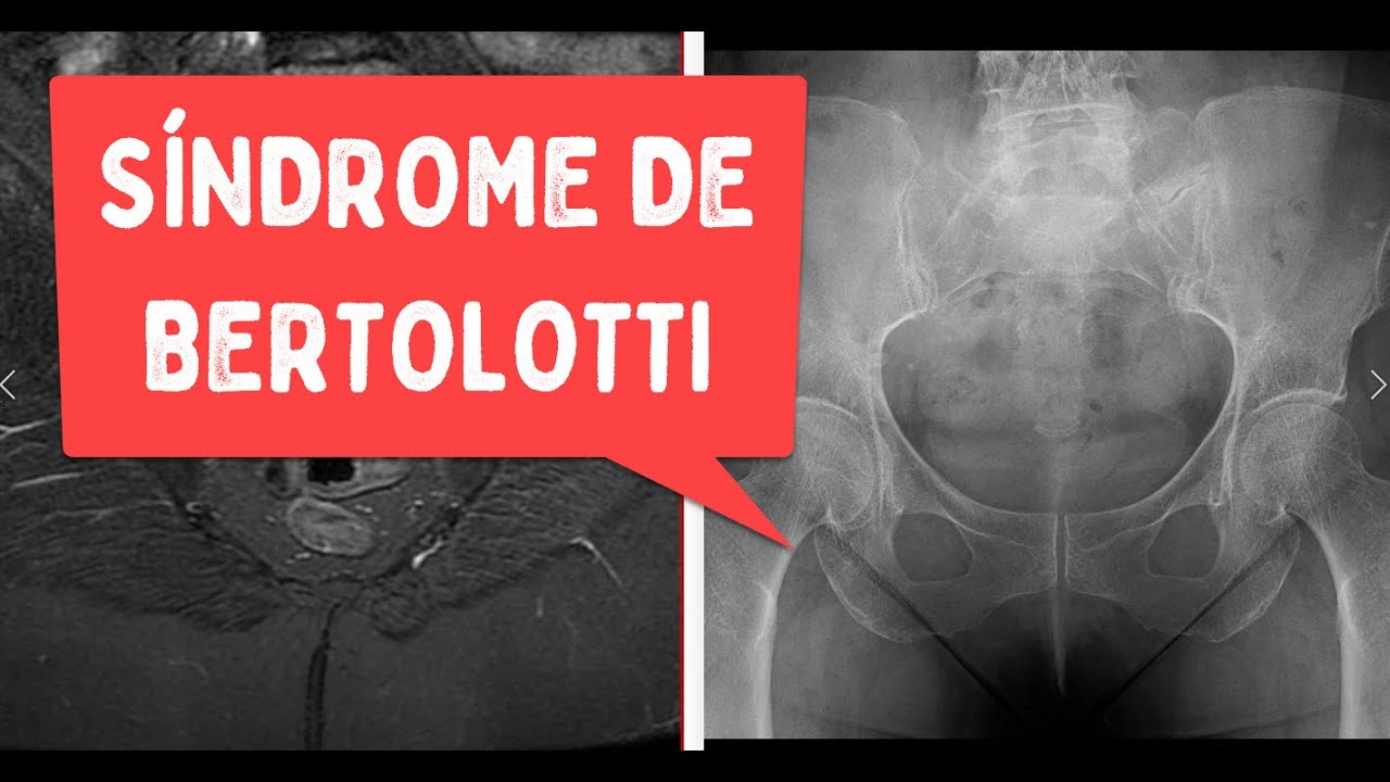 Síndrome de Bertolotti