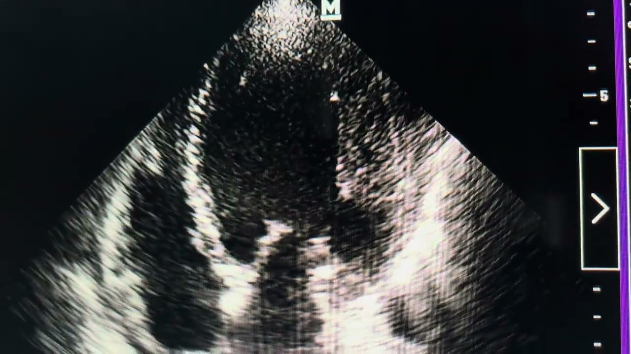 Infarto Anterior Extenso Remodelado