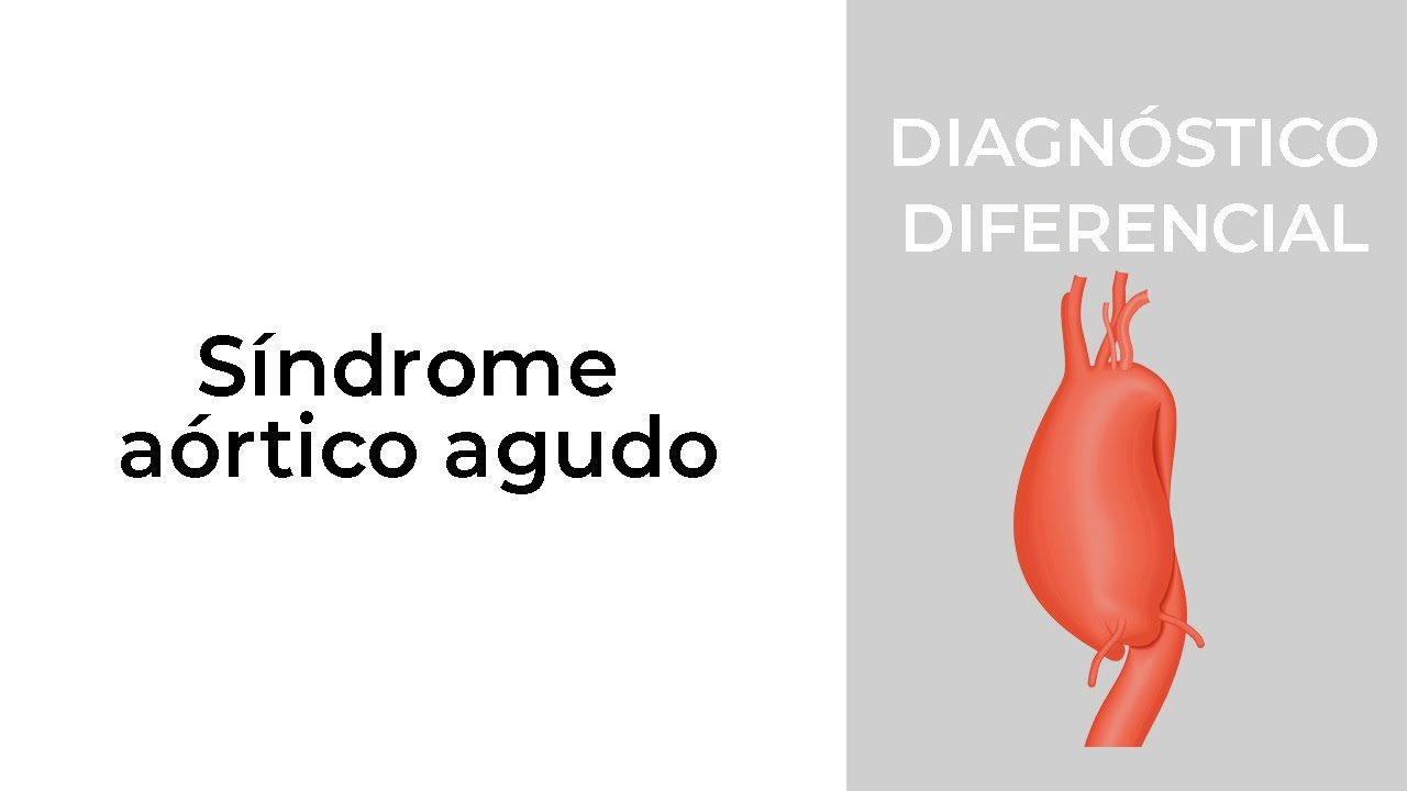 Diagnóstico Diferencial. Síndrome Aórtico Agudo
