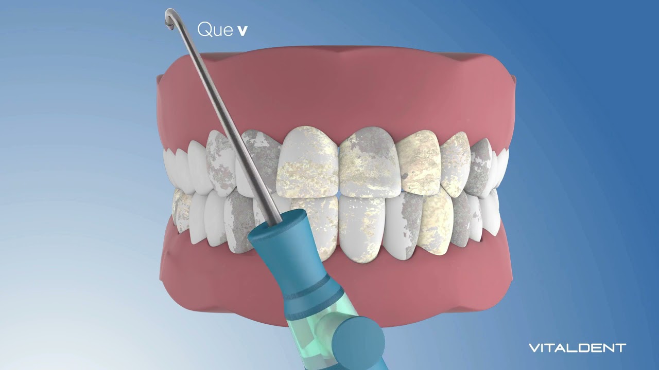 Limpieza dental avanzada - Vitaldent