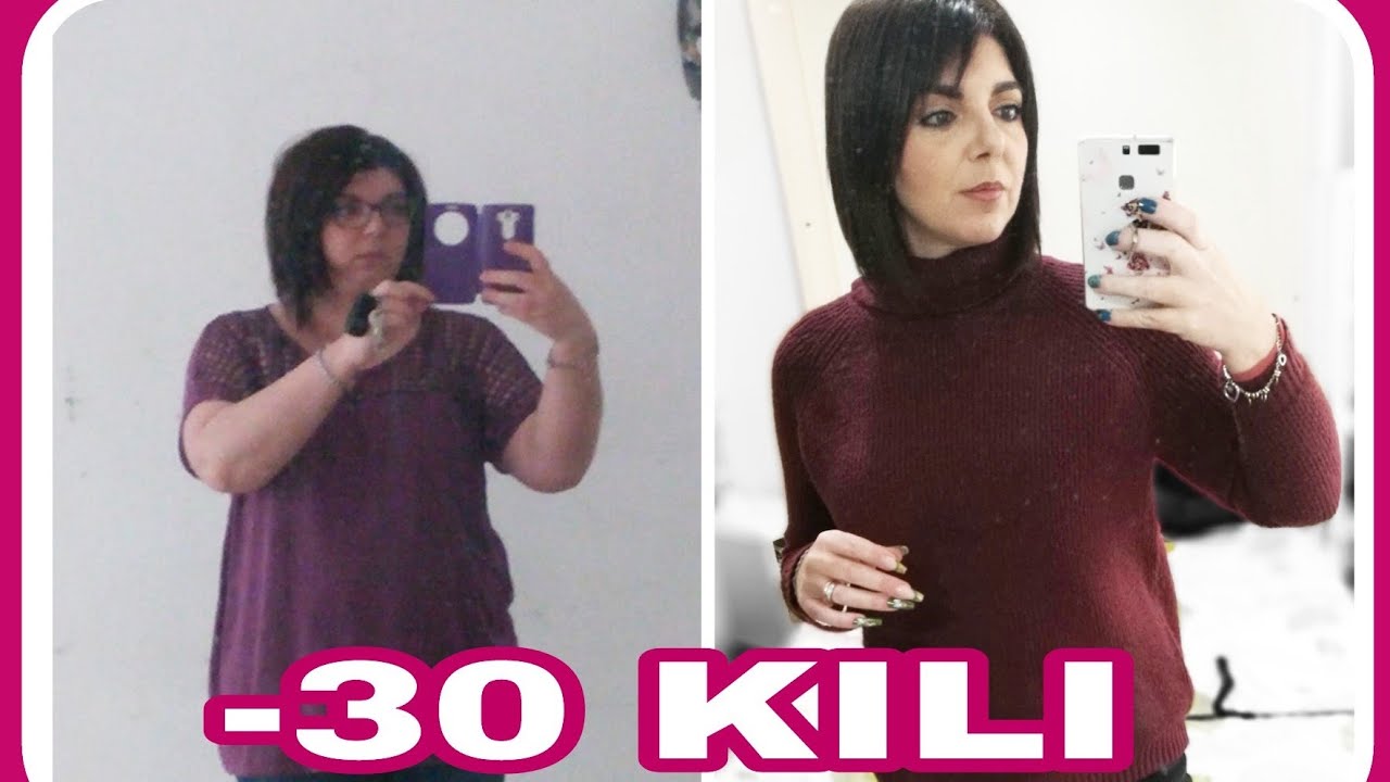 IL MIO DIMAGRIMENTO CON IL BYPASS GASTRICO