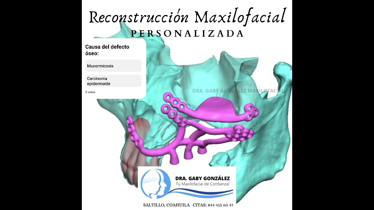 Cirug&iacute;a Maxilofacial Saltillo DRA. GABY GONZALEZ / Reconstrucci&oacute;n Facial Personalizada