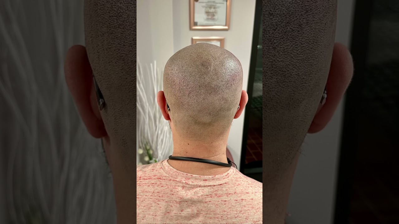 Soluci&oacute;n para la calvicie ! Hair  ! Tatuajes en la cabeza . Cabeza tatuada , peluqu&iacute;n . Toupee !