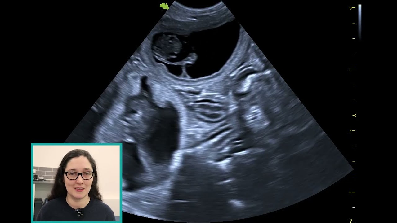 A story of 3 pregnancy scans... 🐱🐱🐱