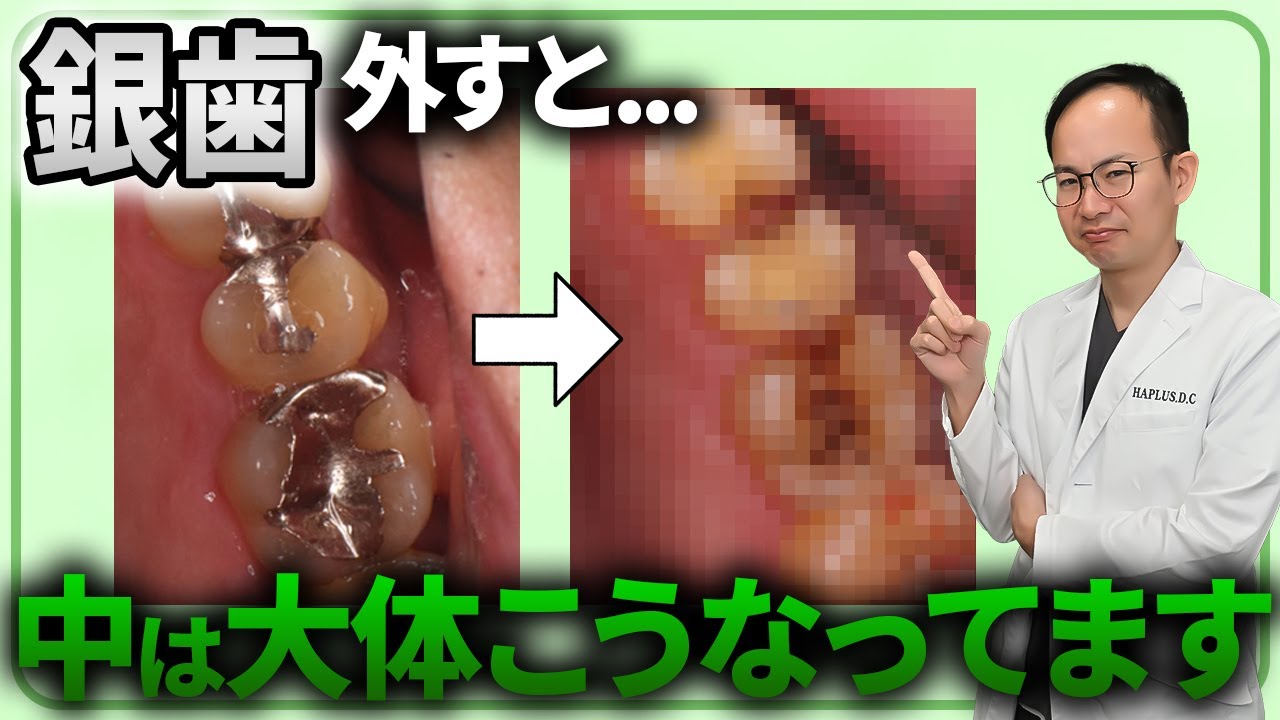 昔に銀歯治療された方は見た方がいいかも...銀歯の詰め物を外すと大体こんなことになっています...