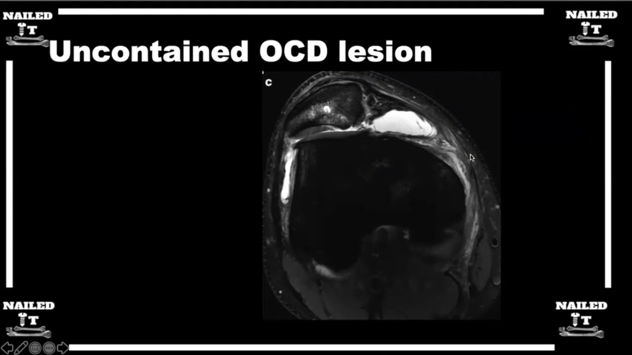 Knee Chondral Lesions on MRI w/ Dr. Saltzman