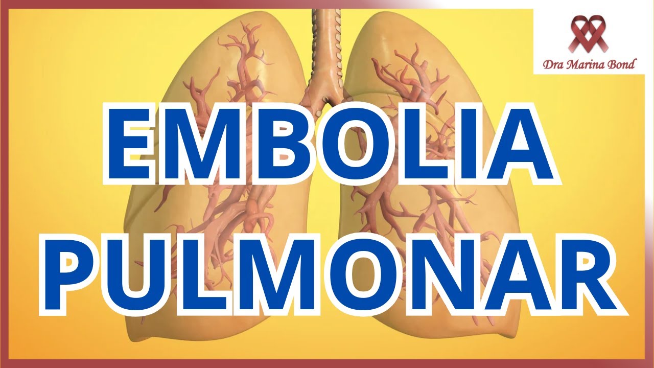 SAIBA TUDO SOBRE EMBOLIA PULMONAR!
