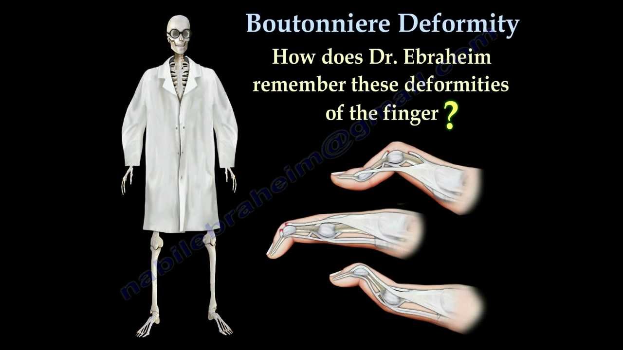 Boutonniere Deformity - Everything You Need To Know - Dr. Nabil Ebraheim