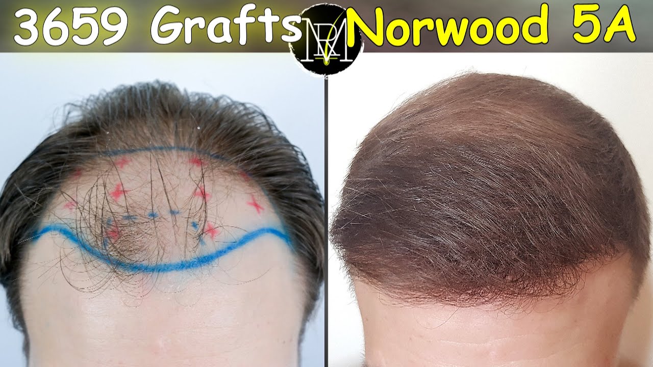 3659 FUE Grafts | NW5a | Thin Hair | 7 Months Result
