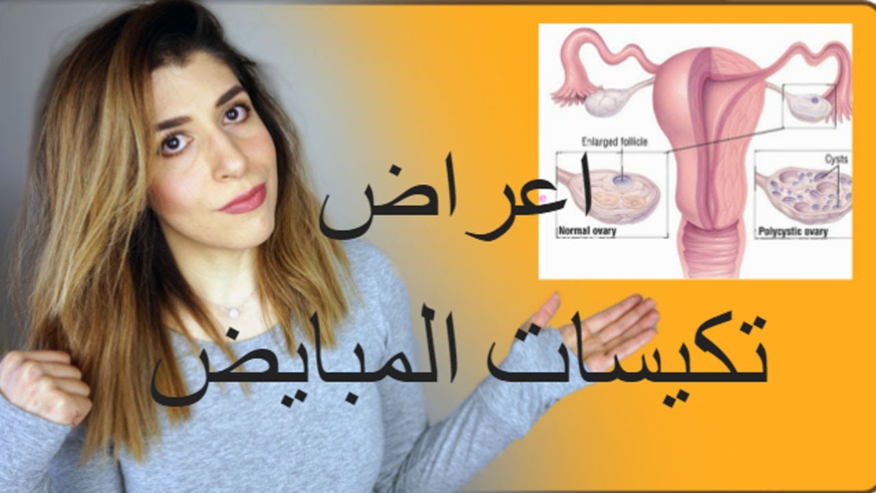 تكيس المبايض (اسباب ظهوره و اعراضه )